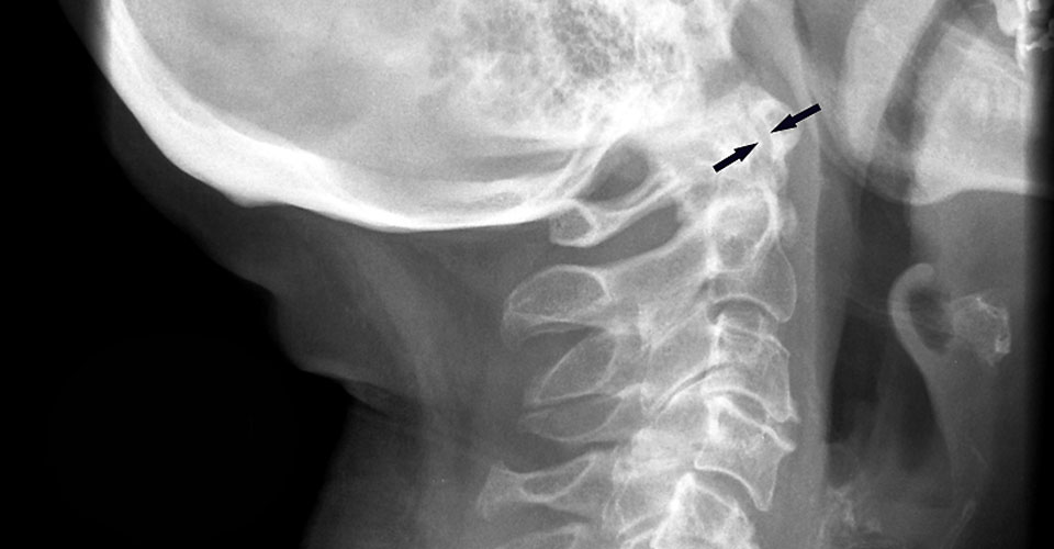 Cervical spine instability flexion